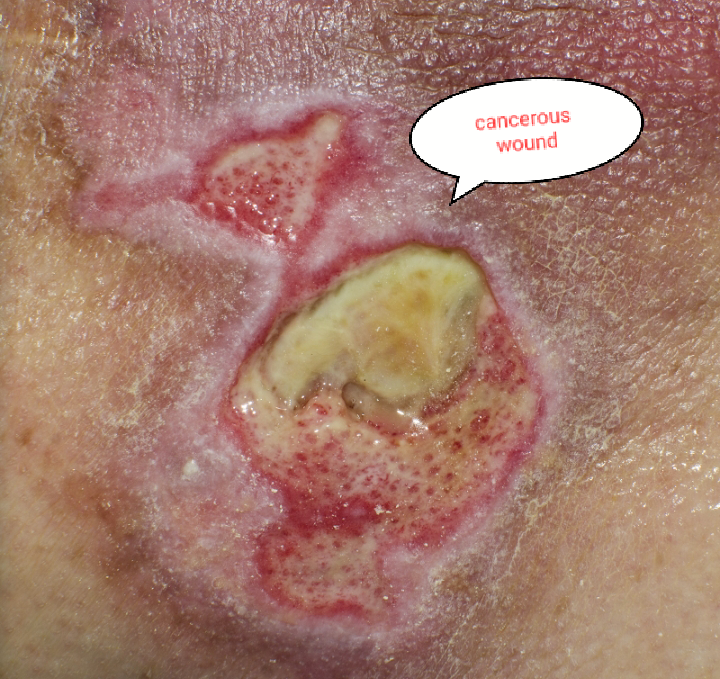 Image of cancer treated with herbs