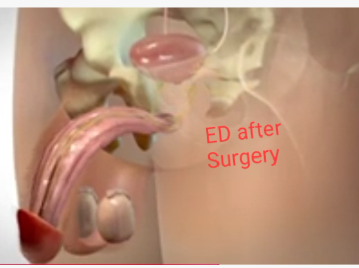 ED after Surgery may be treated with herbs