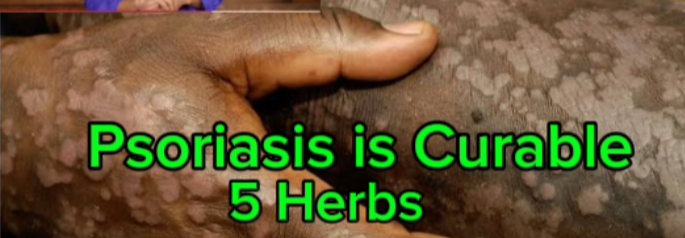 Psoriasis is a disease cure using herbs