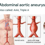 Images of AAA diseases