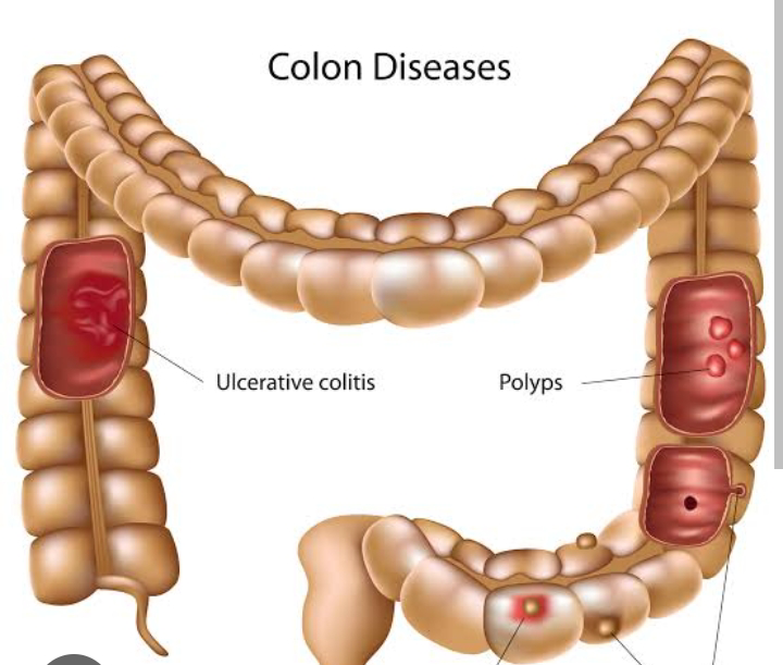 colitis is treated with licorice