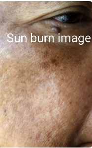 Sun burn face